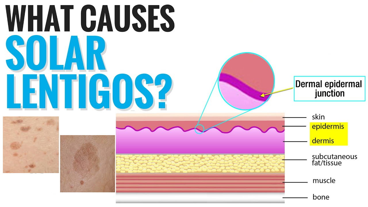 孚美達(dá)“氟輕松氫醌維A酸乳膏”能用于老年斑治療嗎？