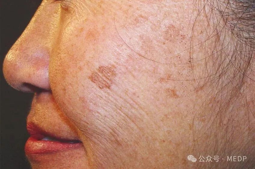 老年斑、曬斑、日光性雀斑是一回事嗎？